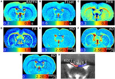 Lysophosphatidyl Choline Induced Demyelination in Rat Probed by Relaxation along a Fictitious Field in High Rank Rotating Frame